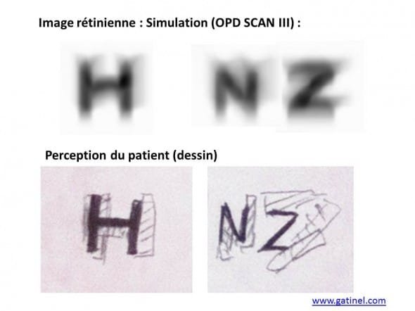 diplopie horizontale, convolution vs dessin vision double