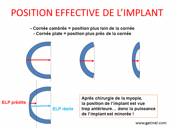 position effective de l'implant 