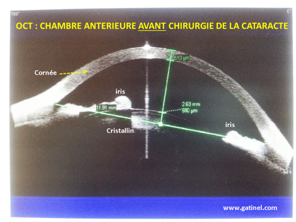profondeur chambre antérieure et posi