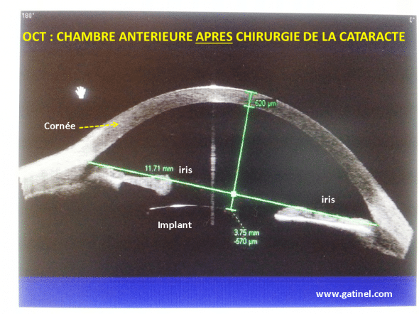 Après la chirurgie de la cataracte, qui consiste en le retrait du cristallin, et l’insertion d’un implant de cristallin artificiel, la chambre antérieure est approfondie. Cette modification est liée au retrait du volume occupé par le cristallin qui faisait « saillie » vers l’avant, en repoussant l’iris, et également au positionnement de l’implant dans le sac capsulaire: l’implant (face antérieure) est situé à environ 570 microns en arrière de l’iris. Il n’est pas possible de prédire avec certitude le positionnement de l’implant vis vis de la cornée, une fois injecté dans le sac capsulaire, après retrait du cristallin. 
