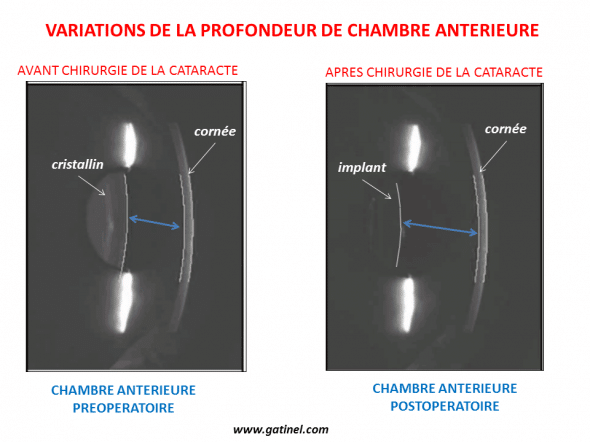 La chambre antérieure est plus profonde après le retrait du cristallin. Le volume de l'implant est nettement inférieur à celui du cristallin.