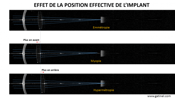 Variations de la position de l'implant IOL Maser 700