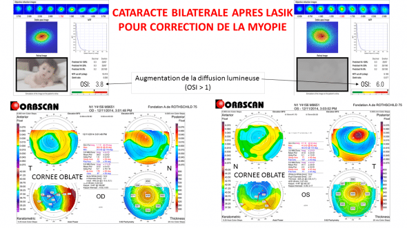 cataracte après LASIK pour myopie