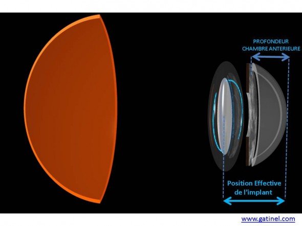 position effective de l'implant biométrie