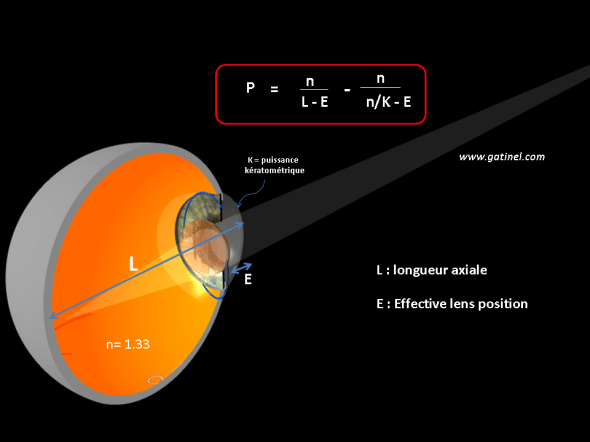 calcul d'implant formule théorique