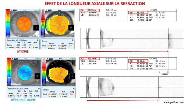 Longueur axiale oeil myope et hypermétrope