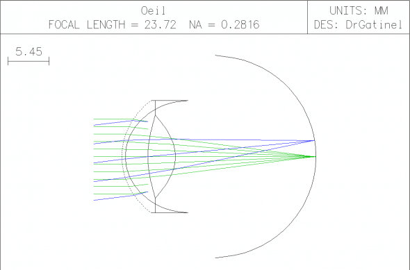 Oeil myope 2D myopei  corrigée