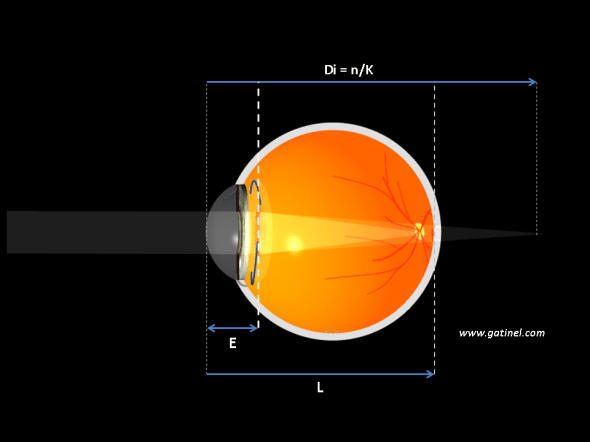 Représentation de la position de l'implant vis à vis de la cornée et longueur axiale