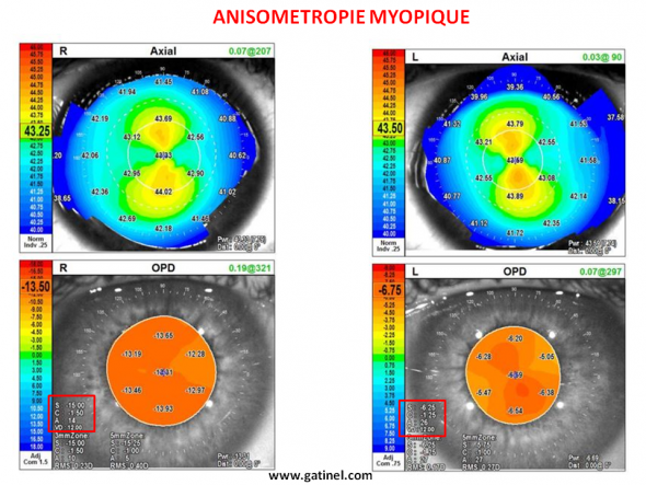 anisométropie myopie