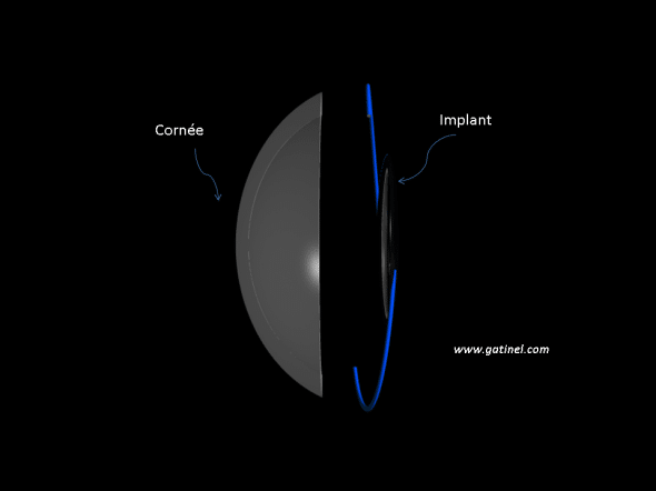 couple cornée et implant