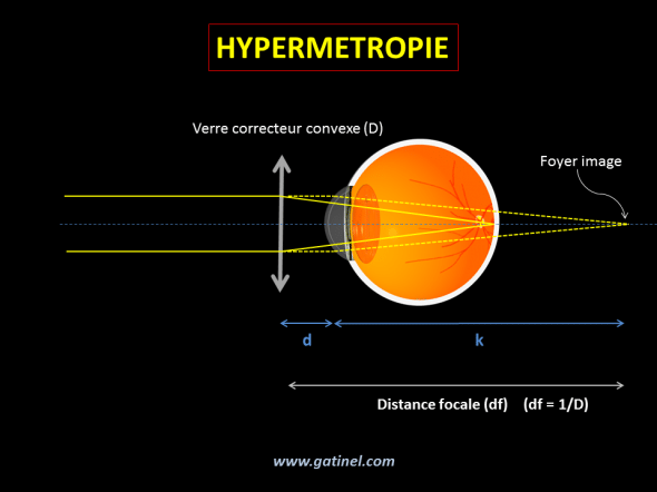 distance verre oeil, calcul de la différence de vergence