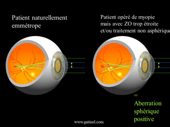 comparaison emmétropie naturelle et post chirurgie réfractive aberration sphérique