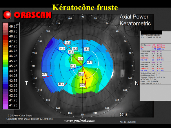asymétrie cornéenne kératocone fruste et anomalie de type SRAX