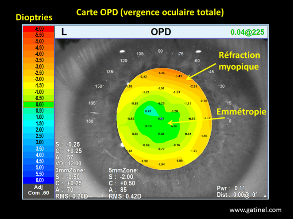 carte OPD aberrations sphériques post chirurgie réfractive