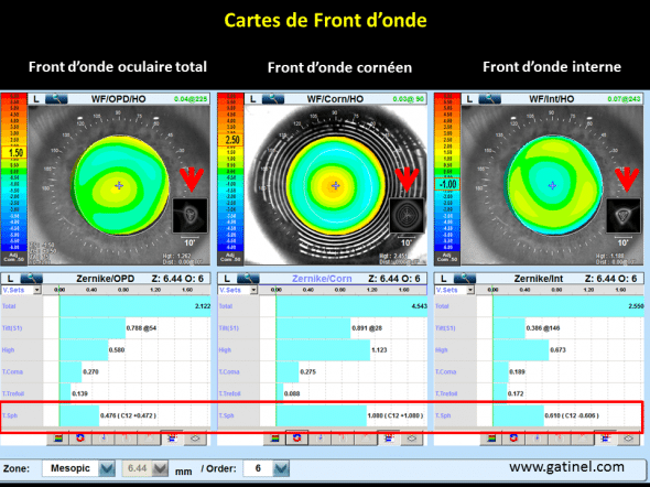 cartes de front d'onde, aberration sphérique positive après chirurgie de la myopie