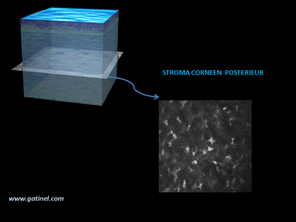cornée HRT microscopie confocale aspect du stroma postérieur