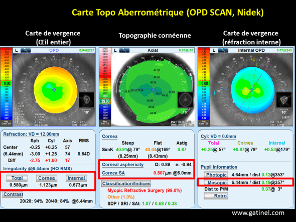 examen topo aberrométrique effectué par l'opd scan avec aberrations sphériques positives