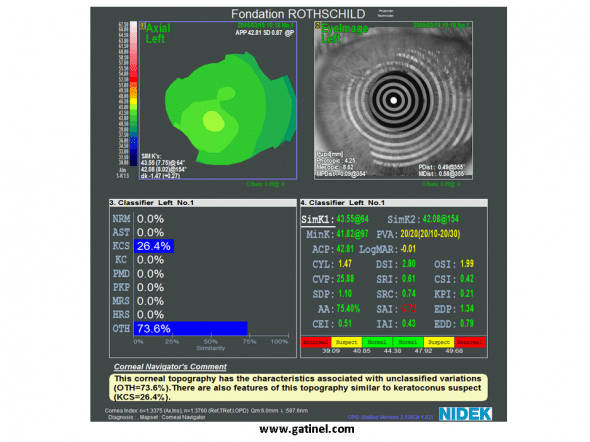 keratocone suspect indices de klyce maeda topographie spéculaire