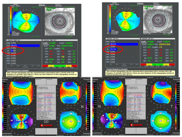 faux positifs pour le diagnostic automatisé de kératocône