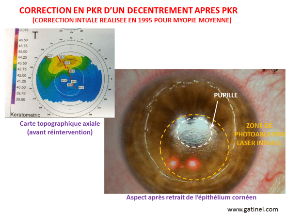 décentrement photablation asymétrie cornéenne