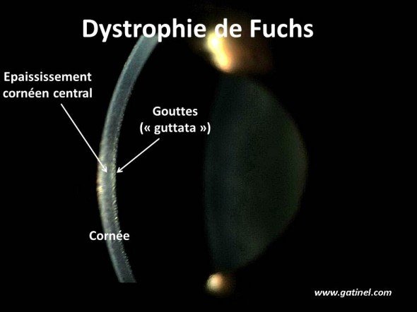 aspect biomicroscopique de la dystrophie de Fuchs