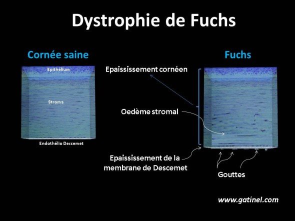 Guttata et dystrophie de Fuchs