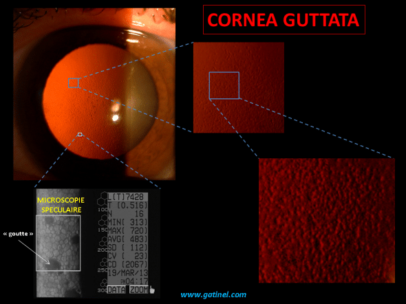 aspect de cornea guttata