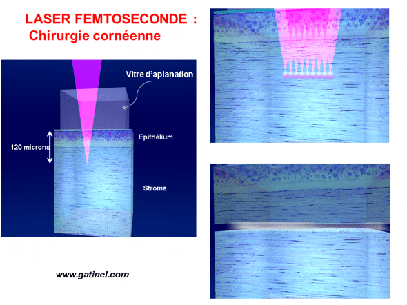 découpe laser femtoseconde