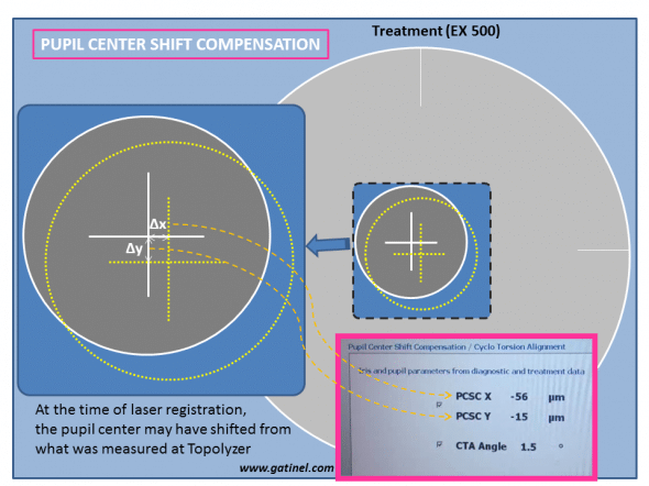 The displacement of the pupil center with regards to the limbus between the Topolyzer reference image and the actual laser image is shown in terms of X and Y distances. 