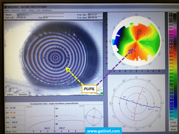 The pupil rim can be delineated and superimposed to the curvature map. 