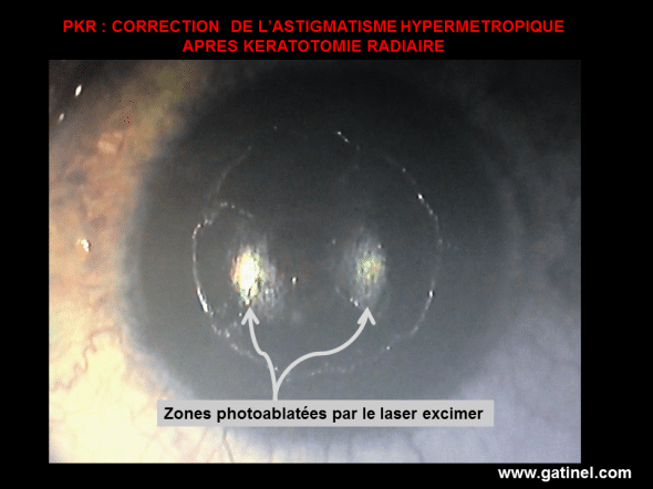 Empreinte laser excimer après PKR sur kératotomie radiaire