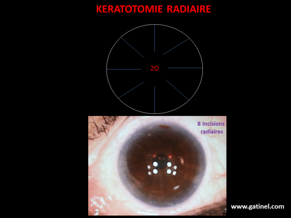 Schéma des incisions de kératotomie radiaire