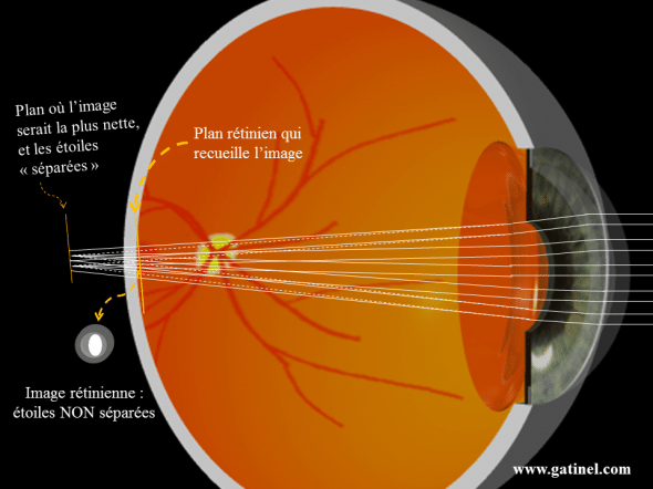 images rétiniennes oeil hypermetrope