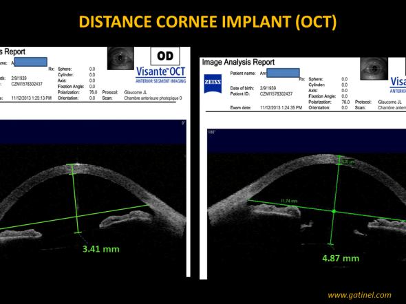 OCT distance implant
