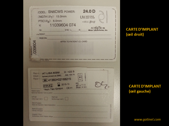 cartes d'lmplants de cristallin artificiel