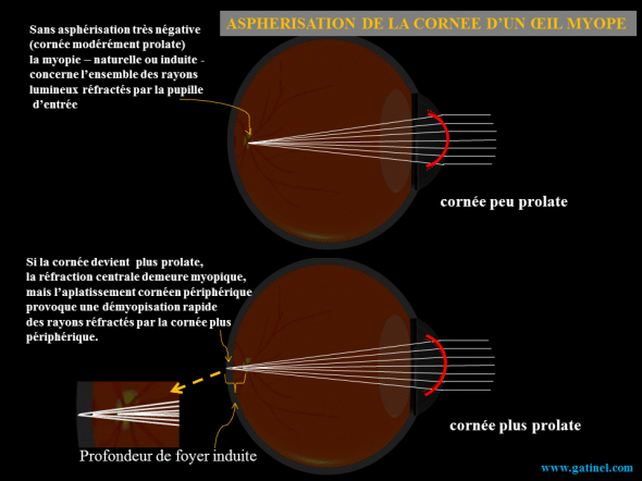 asphérisation et oeil myope