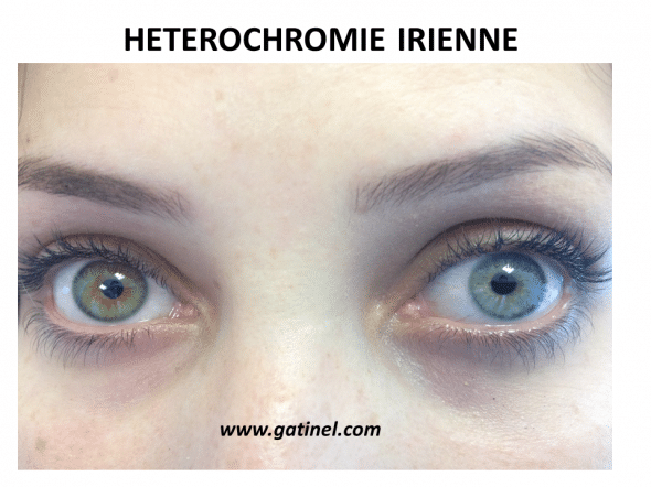hétérochromie irienne, yeux vairons