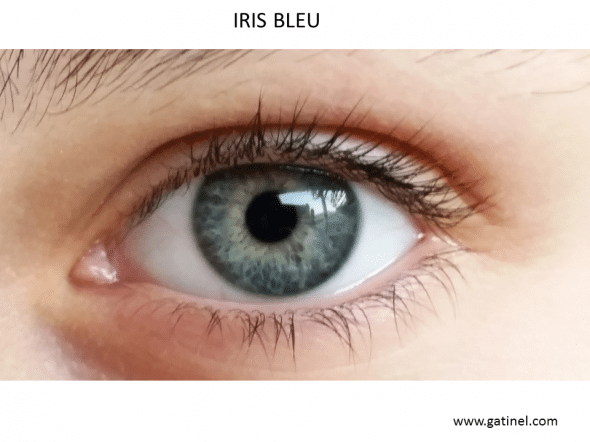 Exemple d’iris (perçu comme) bleu: cette couleur est liée à l’absence de pigmentation de la couche antérieure de l’iris. Les yeux bleus ne possèdent pas un iris bleu (au sens où il ne contient pas de pigment bleu), mais cette couleur est liée à la diffusion préférentielle des courtes longueurs d'onde du spectre visible (tout comme l'atmosphère diffuse préférentiellement le bleu ce qui explique la couleur du ciel). Les variations locales de la couleur de l’iris faiblement ou non pigmenté sur sa face avant sont donc induites par la manière dont le tissu irien diffuse en réflexion la lumière incidente, qui est généralement polychromatique en eclairage naturel (soleil) ou artificiel (ampoules). C'est pour cela que les iris perçus comme bleus présentent souvent des variations apparentes d'intensité ou de bleu, ou encore