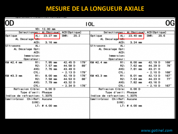 Biométrie oculaire