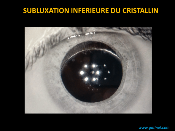 ectopie inférieure du cristallin