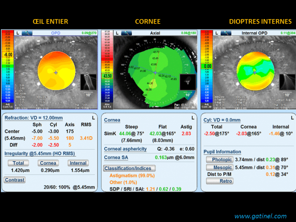 OPDscan III ectopie