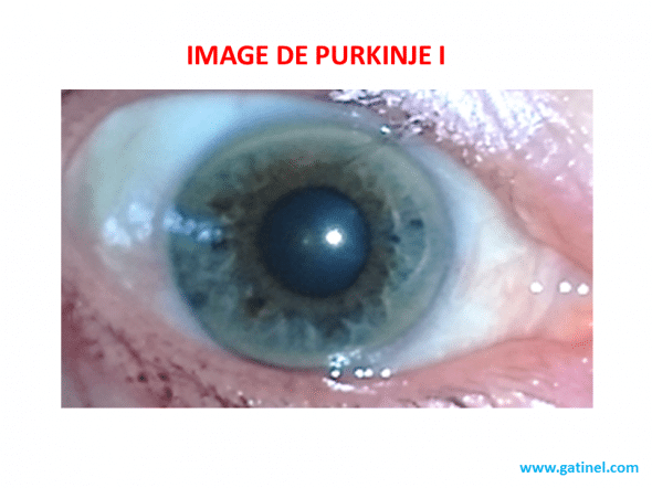 Purkinje I et III