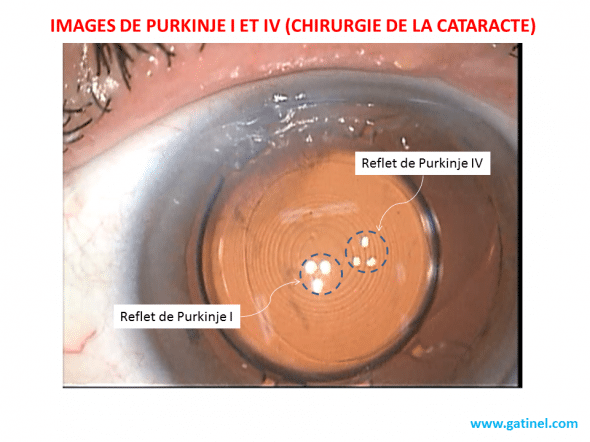 Purkinje I et IV cataracte