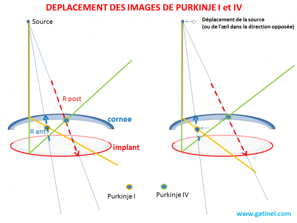 Purkinje I et IV