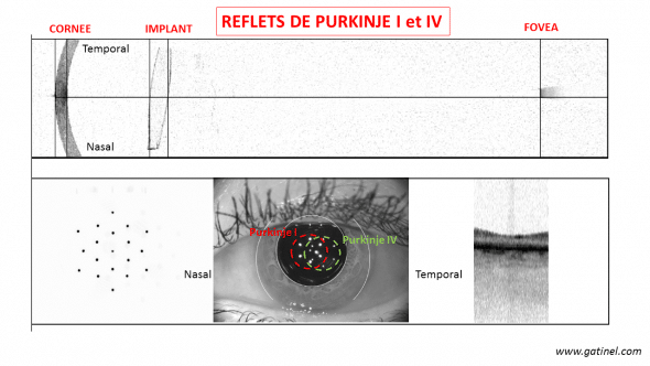 Cliché en lumière visible du segment antérieur (en bas) et coupe OCT (lumière infrarouge) en haut, révélant l'angulation des structures du segment antérieur vis à vis de l'axe optique de l'oeil (l'angle kappa, entre l'axe pupillaire et l'axe visuel est particulièrement prononcé). Notez le "tilt" apparent de l'implant.