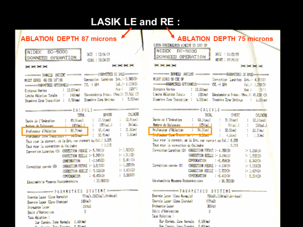laser photoablation depth