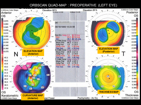 Preoperative Orbscan left eye