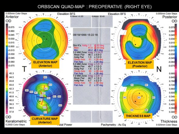 Orbscan quad maps