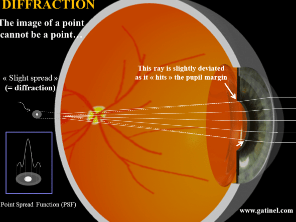 In geometrical optics, light rays are infinitely thin, and can intersect in an infenitesimal point. When lightwaves hit a small obstacle, they are dispersed « around » and beyond it. The edge of the pupil can be seen as a singular obstacle which scatters the light energy in all the directions behind it. However, in practice, most of the incident light energy will be scattered within a small angle, especially when the pupil is large. This is equivalent to consider that the margninal ray is slightly displaced « outward ». In a perfect eye, at the foveal plane, light energy will be spread, as some lightwaves will not interfere constructively in the very center of the formed figure. The point spread function describes the combined effect of aberration and diffraction on the repartition of the light energy at the foveal plane, which is the net result on how the light interferes at that plane. In a « perfect eye », also called « diffraction – limited eye », the point spread function (PSF) is a small patch bright disk surrounded by a very faint halo of light energy. Interestingly, the smaller achievable dimension of the disk (1.5 microns) is about the same size of the smallest foveal cones (attained when the pupil is fully dilated, as the effect of diffraction is minimized). For a specific pupil diameter, the height of the peak of the diffraction limited PSF can serve as a reference. The « Strehl ratio » correpsonds to the ratio between the maximal height of the eye’s PSF and the diffraction limited PSF. Because of the effect of the monochromatic aberrations which impair the optical quality of any biological system such as the human eye, monochromatic Strehl ratio of the « best » (less aberrated) eyes is not higher than 0.15. En optique « géométrique », on considère que les rayons on une épaisseur nulle, ils matérialisent une direction de propagation de la lumière et peuvent se couper en un « point » mathématique, de dimension infiniment petite. En pratique, il est impossible de réaliser des images strictement ponctuelles (stigmatisme rigoureux), en raison du phénomène de diffraction. La diffraction est liée à l’aspect ondulatoire de la lumière, et concerne le comportement de la lumière au voisinage des obstacles (ici les bords de la pupille). On peut considérer de manière simplifiée que les bords de la pupille provoquent une légère déviation des rayons qui passent « juste au contact » des bords de la pupille irienne. De ce fait, la tache d’éclairement rétinien d’un point source comme une étoile dont le diamètre serait pourtant 