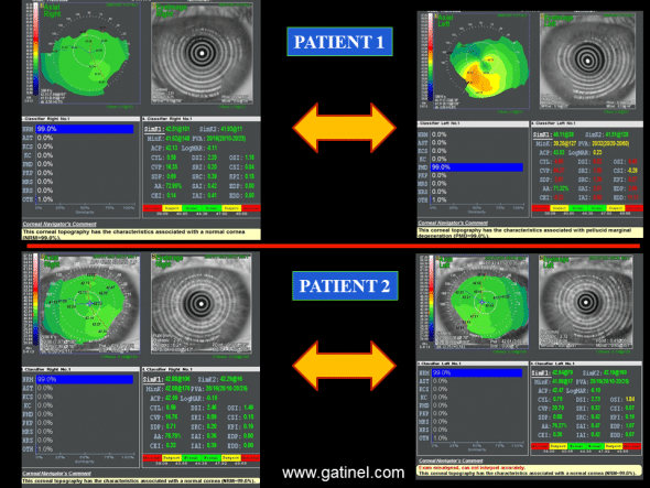 FFKC vs suspicious cornea